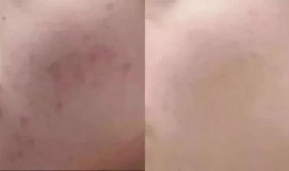 有咽炎的明星,揭秘咽炎明星的康复之路