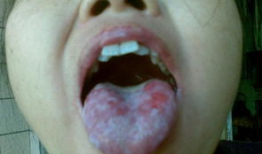 舌头烂了的图片