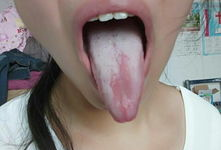 舌头烂了的图片